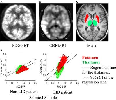 Blood Flow and Glucose Metabolism Dissociation in the Putamen Is Predictive of Levodopa Induced Dyskinesia in Parkinson's Disease Patients